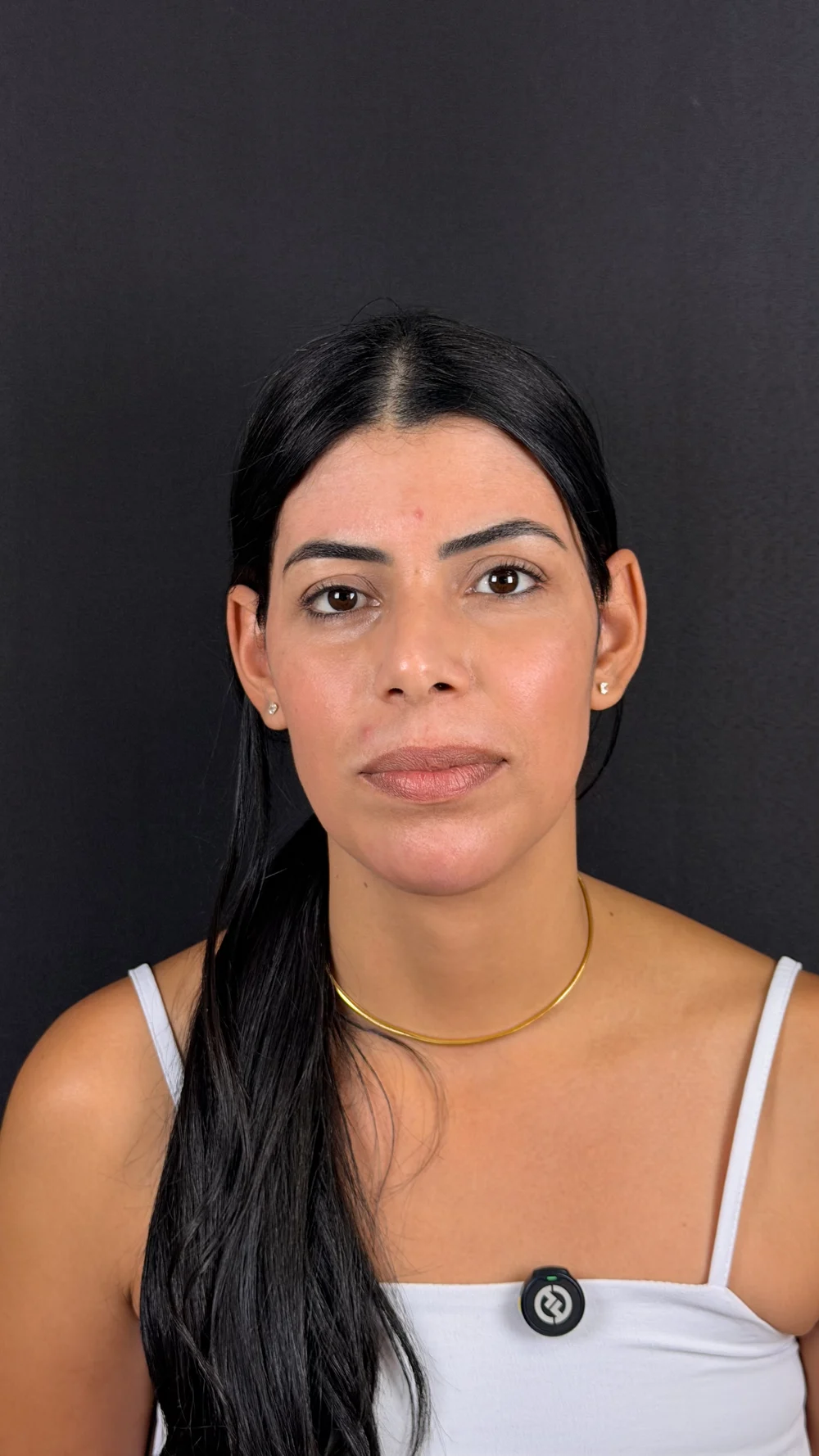 Depois de tratamento de melasma